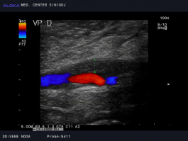 Ultrazvok žil nog - subakutna tromboza vene v kolenu (v. poplitea)